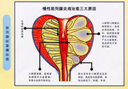 前列腺腔道介入技术 前列腺腔道介入技术